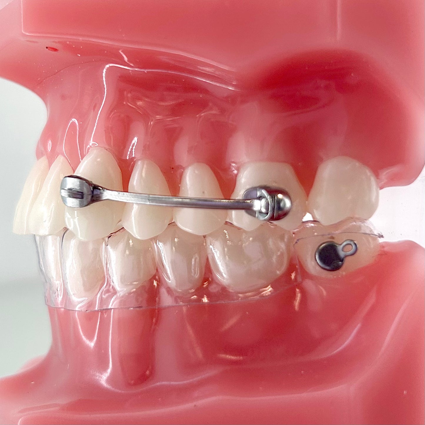 Distalizador de Carrier | Ortho Organizer